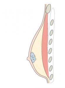 Schematischer Querschnitt einer echten Gynäkomastie (Gynaecomastia vera) mit vermehrtem Fettgewebe. Zwischen der Haut und dem Brustmuskel befindet sich Brustdrüsengewebe und vermehrtes Fettgewebe.