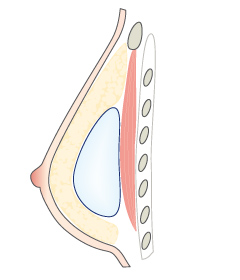 Implantat über dem Brustmuskel mit genügend Ummantelung